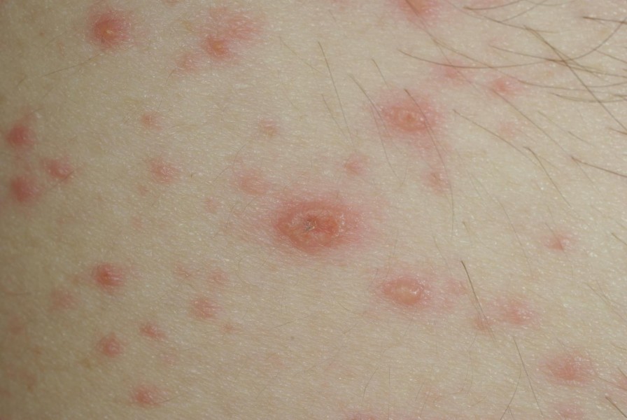 Traitement de la varicelle : que faut-il surveiller ?